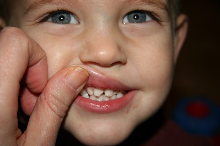शिशु के दातों में संक्रमण के 7 लक्षणों